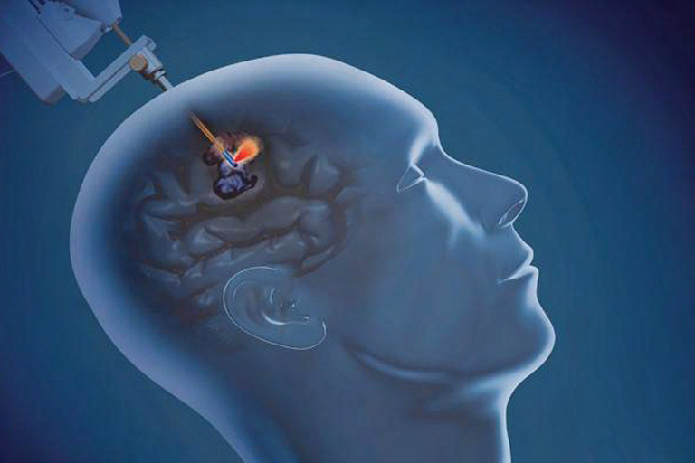 Laser Interstitial Thermal Therapy for Epilepsy