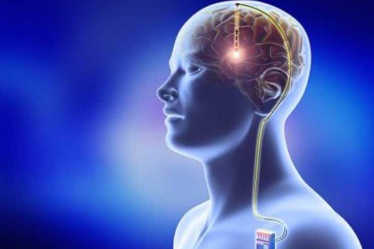 Types of Brain Surgery for Epilepsy
